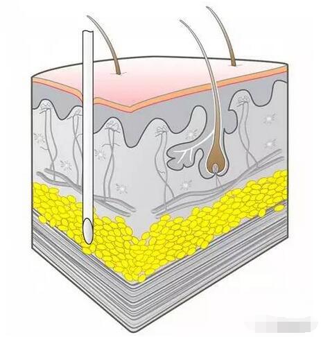 一图看懂 四种注射方式
