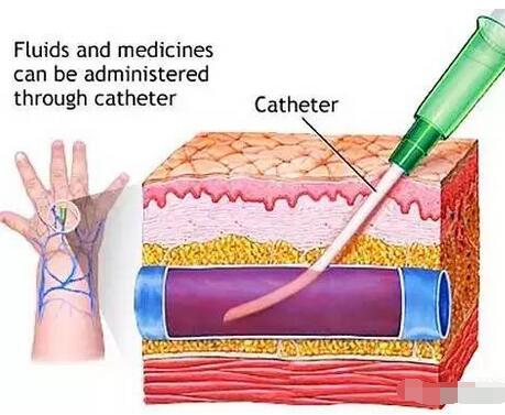 一图看懂 四种注射方式