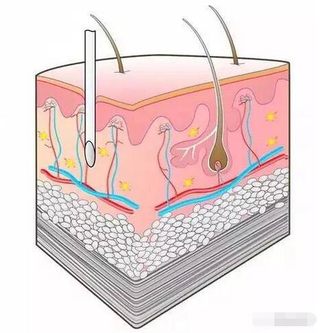 一图看懂 四种注射方式