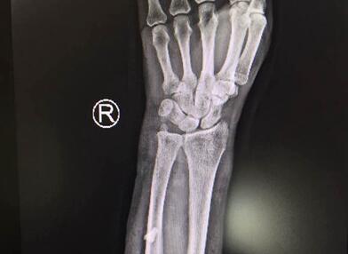 大猪发狂妻子伸手救丈夫 结果右臂被严重咬伤