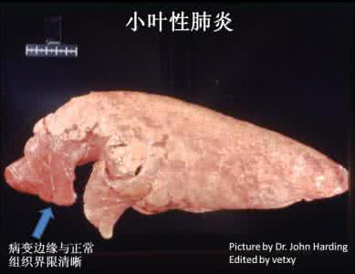 猪支原体、胸膜肺炎肺部病变鉴别及治疗，你掌握了吗？